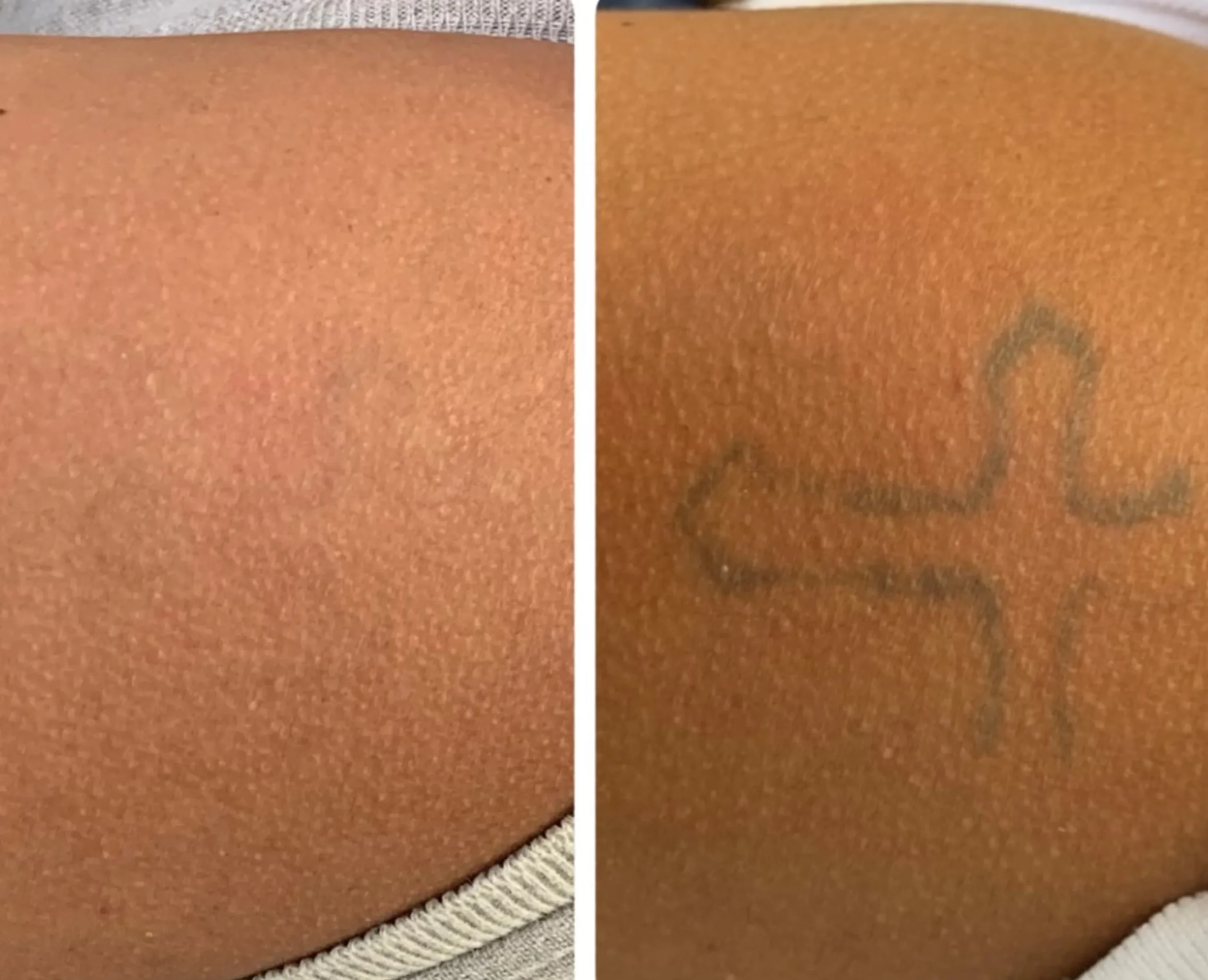 how much is laser removal tattoo