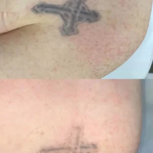 Is Tattoo Removal Worth It? Costs, Methods & Effectiveness