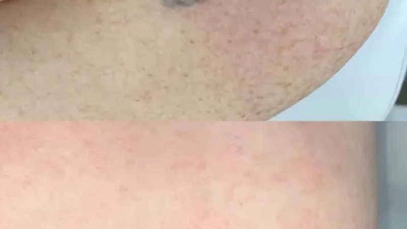 Is Tattoo Removal Worth It? Costs, Methods & Effectiveness