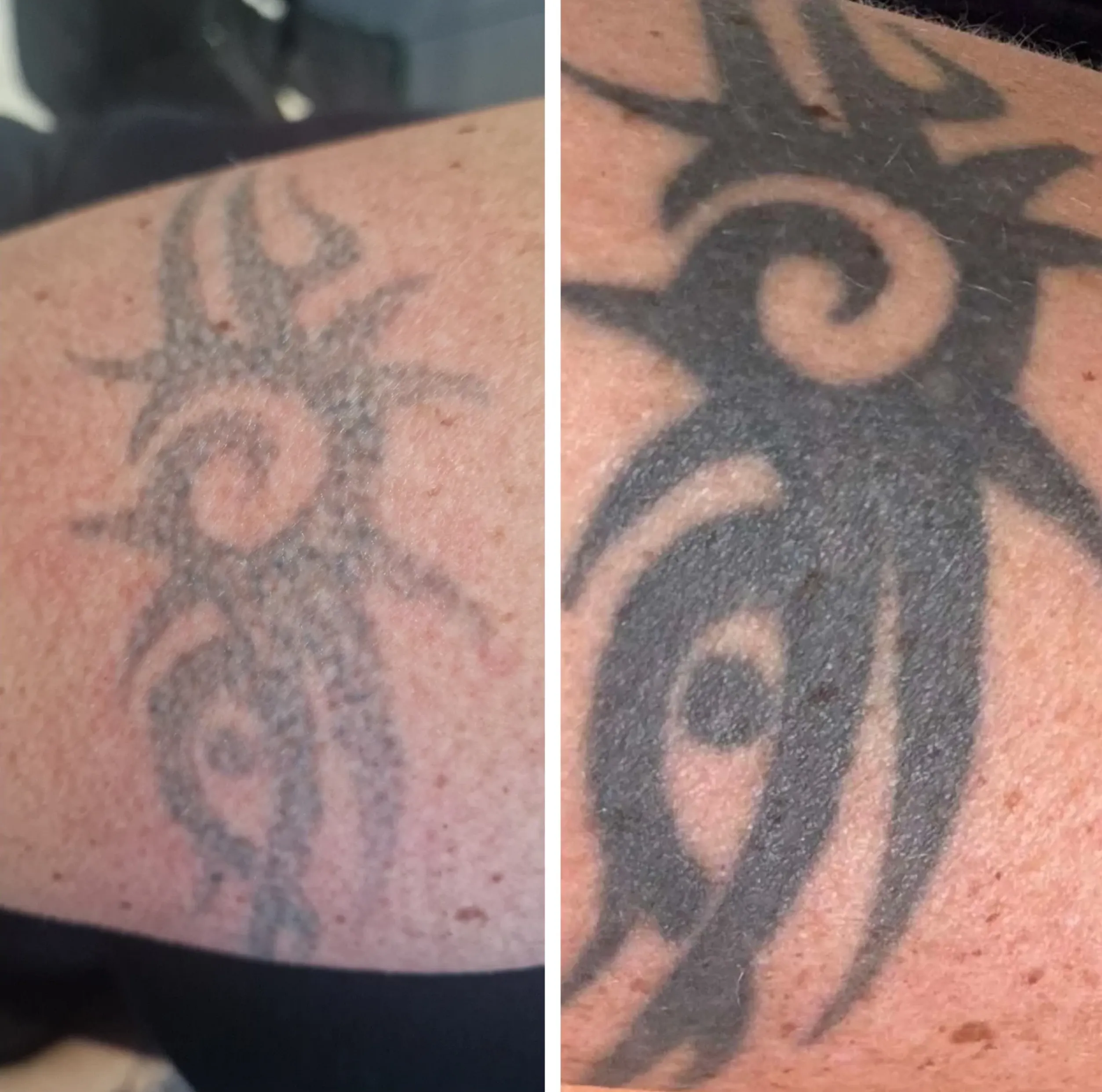 tattoo removal price