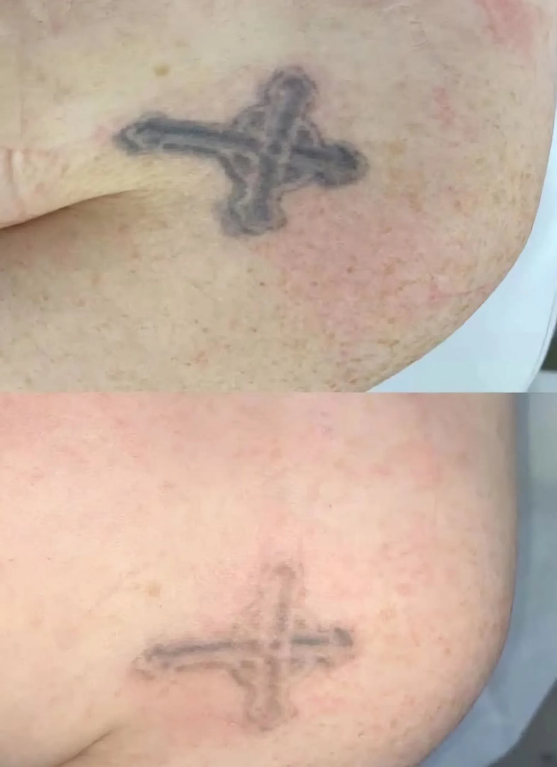 Is Tattoo Removal Worth It? Costs, Methods & Effectiveness